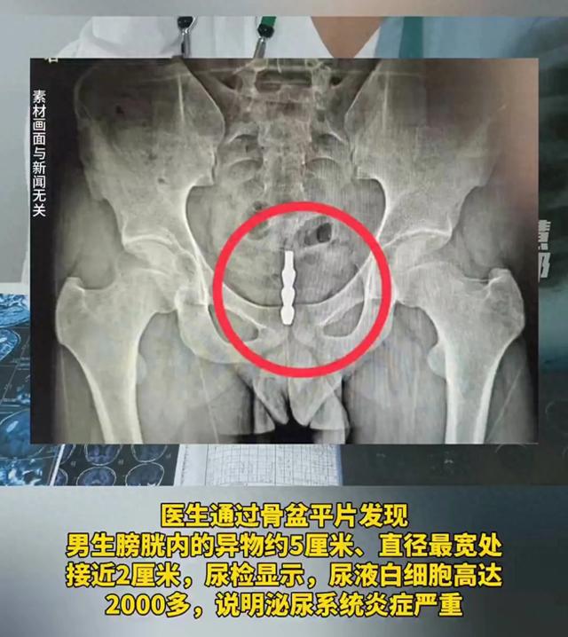 福建一大學(xué)生將螺旋狀鋼管塞進(jìn)尿道不料異物一路“溜”進(jìn)膀胱(圖1)